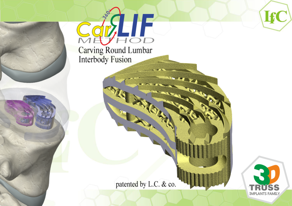 CarRLIF Carving Round Lumbar Interbody Fusion, patented by L.C. & co.
